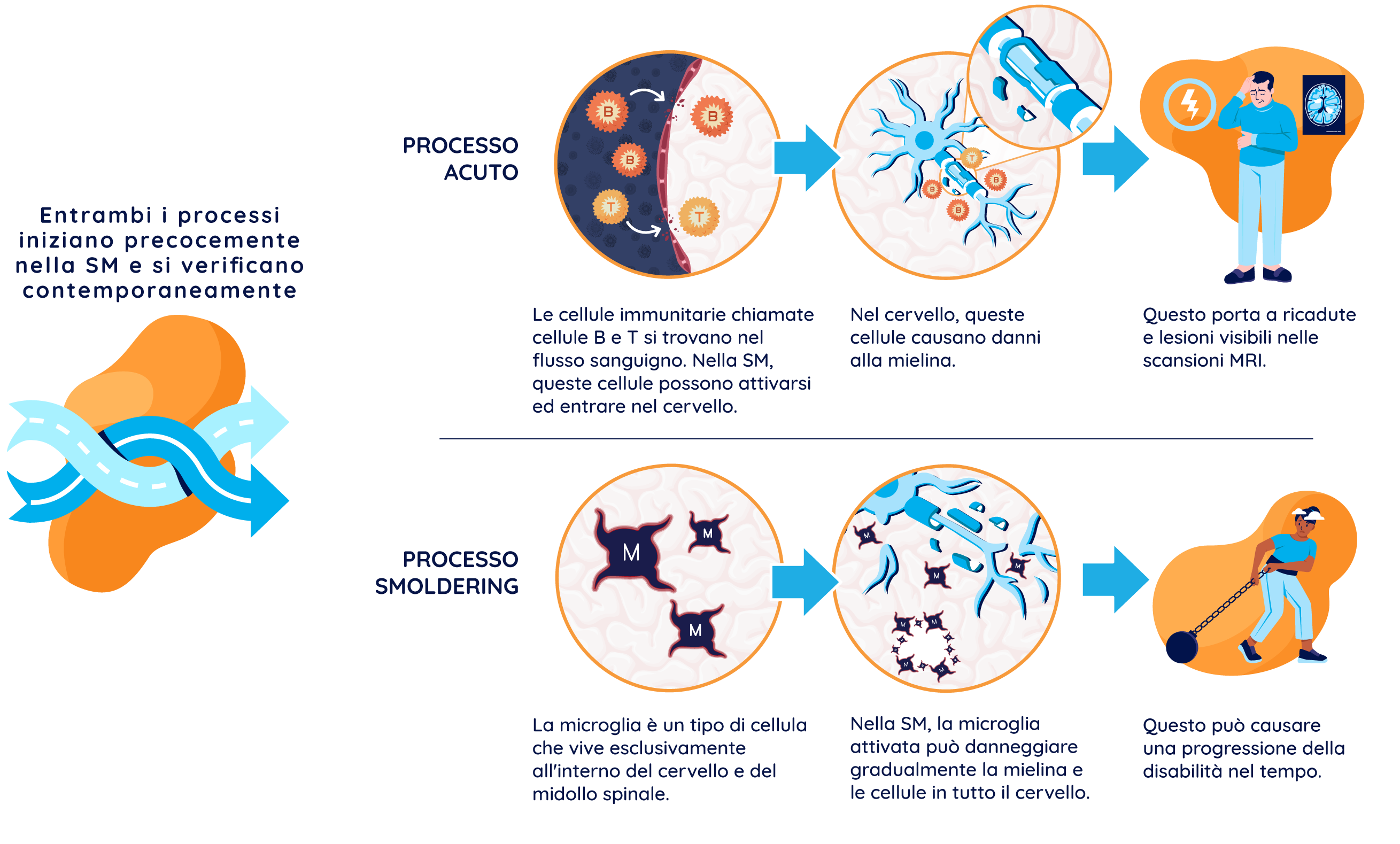 Illustrazione che mostra i processi acuti e smoldering eliminare della SM: mostra il processo acuto in cui le cellule B e T attivate attraversano la barriera emato-encefalica e causano recidive e attività MRI, nonché il processo smoldering in cui la microglia attivata causa la progressione della disabilità